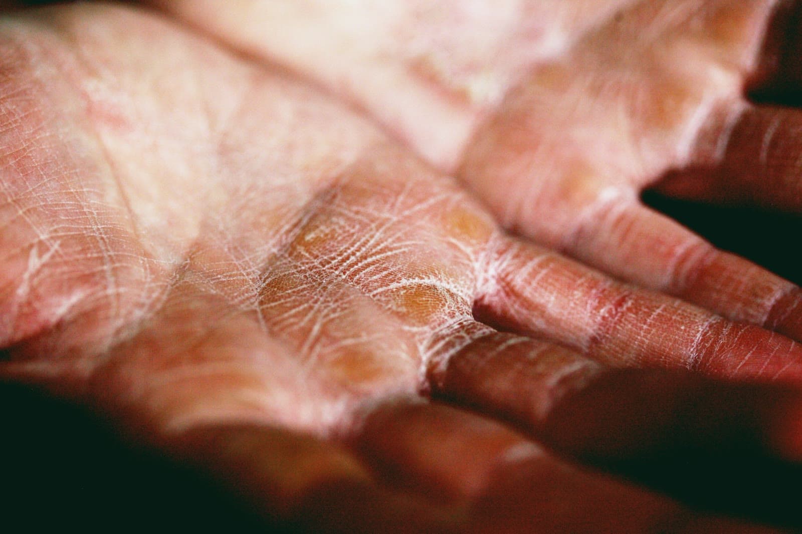 Close-up of dry, cracked skin on the palms